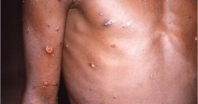 Ministerio de Salud Pública notifica primer caso sospechoso de la Viruela Símica