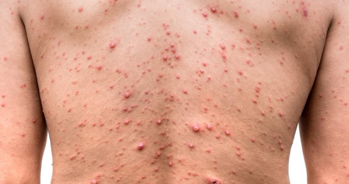 Contacto por la piel es principal vía transmisión viruela símica