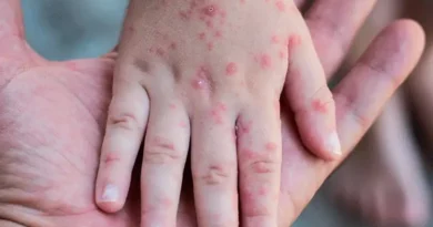 Salud Pública notifica nuevo caso de viruela símica; ya son 32