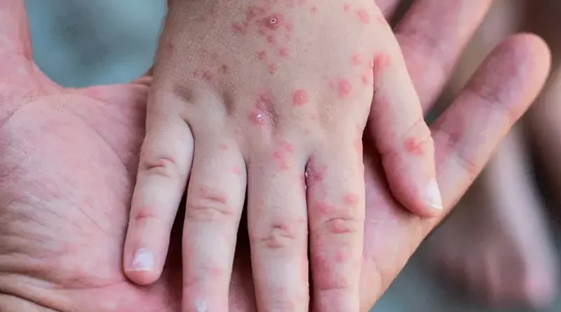 Salud Pública notifica nuevo caso de viruela símica; ya son 32