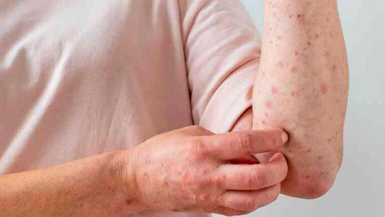 Panamá reporta ocho casos más de viruela símica y acumula 118