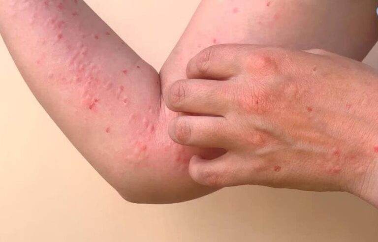 Salud Pública emite alerta epidemiológica contra chikungunya
