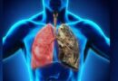 Científicos crean algoritmo para predecir casos cáncer de pulmón