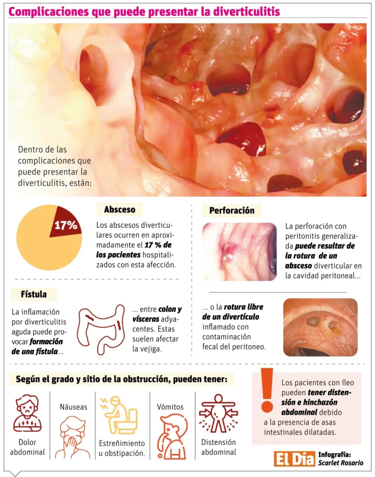 Síntomas y complicaciones de la diverticulitis, una enfermedad en el colon