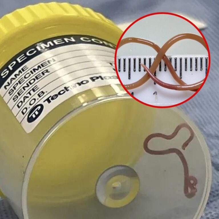 Extraen del cerebro de una australiana una lombriz intestinal viva de 8 centímetros