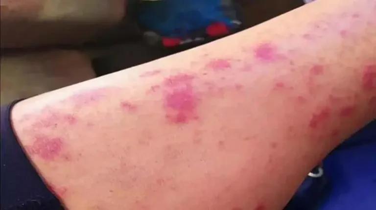 Estados Unidos alerta por bacteria “come carne” en costa este del país