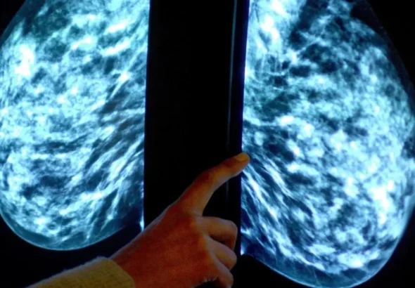 Cerca de 7,500 personas han padecido cáncer en RD entre el 2019 y el 2025; mujeres duplican en casos a hombres